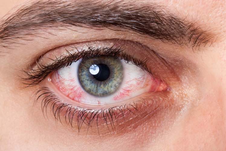 28 Home Remedies for Red Eyes
